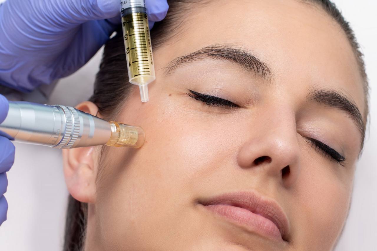 Microneedling